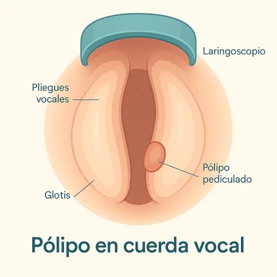 Ilustración de pólipos vocales