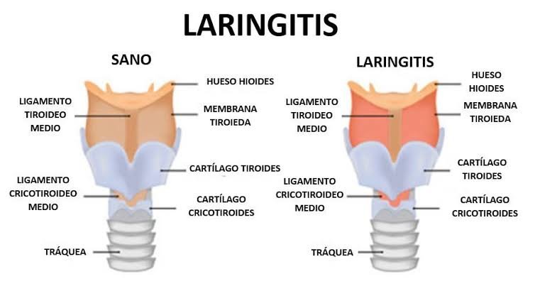 Ilustración de laringitis